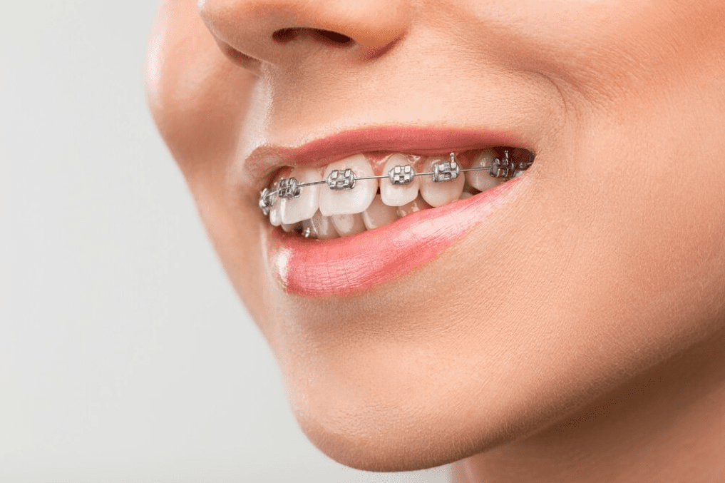 Corregir la posición de los dientes en la edad adulta