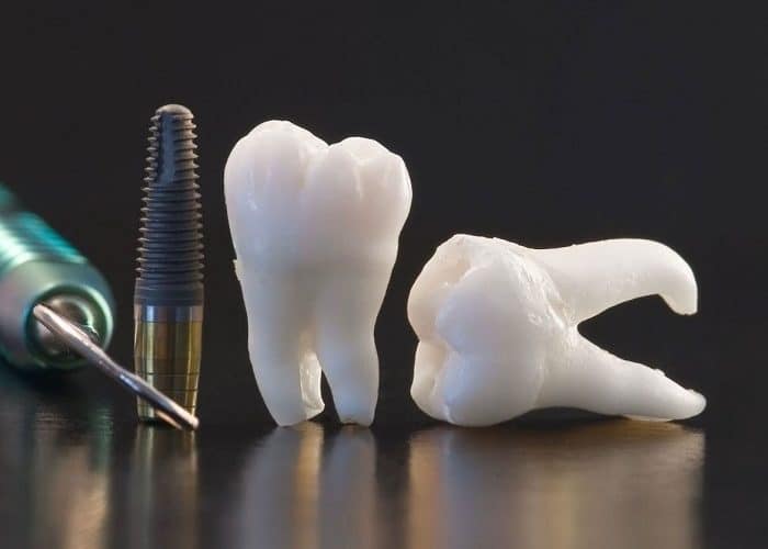 Cómo elegir la mejor clínica dental para implantes