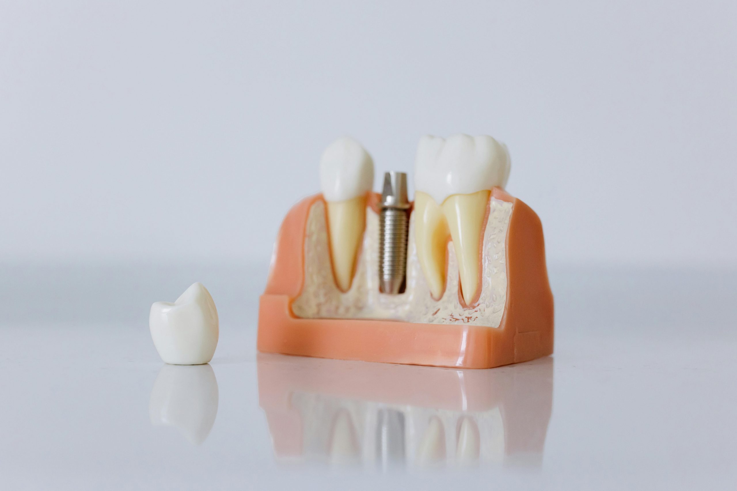 Implantes Dentales vs. Puentes: ¿Cuál es la mejor opción para ti? | Clínica dental Madit | Dentista en Vallecas maqueta de implantes dentales